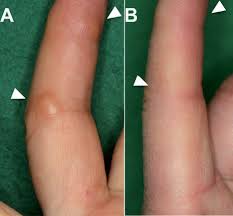 We did not find results for: Methotrexate Induced Accelerated Nodulosis In A Patient With Rheumatoid Arthritis And Scleroderma Html Acta Dermato Venereologica