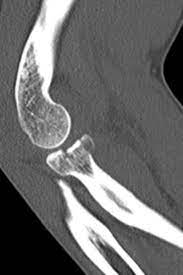 Hallo , ich bin mit meinem mtb gestürzt und habe jetzt eine undislozierte intraartikuläre radiuskopffraktur im ellenbogen links. Radiuskopffraktur Op Arcus Kliniken Pforzheim