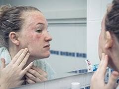 Apple cider vinegar is thought to help eczema, dermatitis, irritations, itchy skin, rosacea and tinea funguses. Atopic Dermatitis 6 Effective Home Remedies To Prevent Eczema Flares