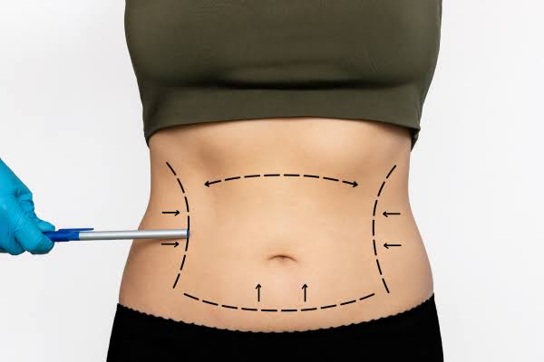 Best Liposuction Surgery In Dubai By Dr Frank Conroy