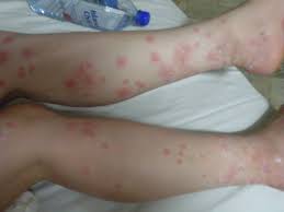 Allergic Reaction Black Ant Bites Pictures This Is A Person Who Has Had A Really Bad Night Sleeping Look At All The Different Bed Bug Bites Bed Bug Bites Bed Bug Bites Pictures Bug Bites On Legs