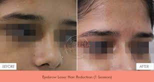 The pigment in the hair follicle absorbs the pulse, which damages the follicle enough to slow hair regrowth. Best Laser Hair Removal Clinic In Delhi Laser Hair Removal T