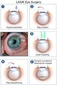 Your eye doctor is best able to help you decide when and if you are candidtate for lasik. Lasik Eye Surgery For Vision Correction At Fort Worth Eye Associates