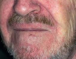 De cele mai multe ori, durerea de cap este un semnal de alarma pe care organismul il transmite atunci cand se confrunta cu. Dermatita In Cap Poze Wasatchpremiermovers Com