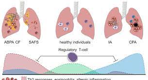 Allergic bronchopulmonary aspergillosis (abрa) is a chronic infectious allergic pulmonary disease caused by aspergillus. The Role Of Regulatory T Cells In Aspergillosis Regulatory T Cells Download Scientific Diagram