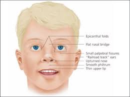 Epicanthal fold, epicanthus, or simply eye fold are names for a skin fold of the upper eyelid, covering the inner corner (medial canthus) of the eye. Fetal Alcohol Spectrum Disorders American Family Physician