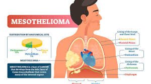 Maybe you would like to learn more about one of these? What Are The Warning Signs Of Mesothelioma