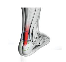 Sorry about the lighting in the second half. Shockwave Therapy For Insertional Achilles Tendinopathy