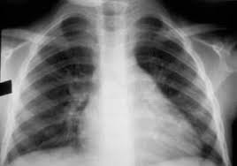 Image result for XRay Changes in Rheumatic Conditions