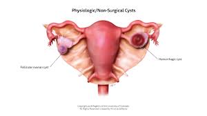 Image result for Cyst