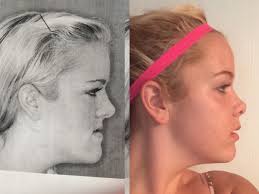Here you may to know how to fix underbite. Can Someones Faceshape And Facebonestructure Be Changed General Discussion Pretty Ugly Little Liar