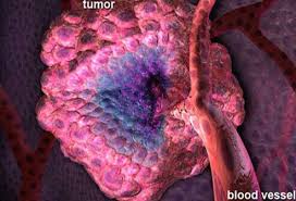 The survival rate in this type of cancer can be as high as 90 percent provided it is detected early in stage i itself. Ovarian Cancer Symptoms Signs Stages