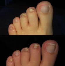 In this post, we have listed prevention & remedies to treat nail tea tree oil can be used to treat onychomycosis. 17 Products That Might Actually Help With Foot Fungus