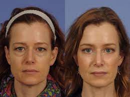 Midface Lift Before After Gallery W Cosmetic Surgery Eye Lift Surgery Eyelid Surgery Eye Surgery