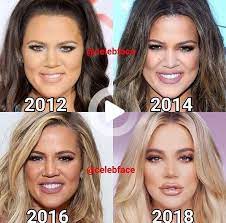 Chloe Kardashian Celebrity Plastic Surgery Chloe Kardashian Celebrity Surgery