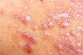 Image result for dermatitis contacta children