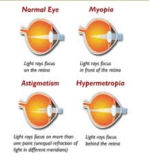 Image result for Refractive Error