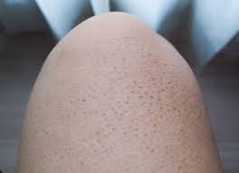 Image result for Keratosis pilaris
