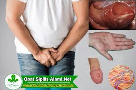 Meski demikian, pada tahap ini, infeksi sudah bisa ditularkan ke orang lain. Obat Sipilis Untuk Pria Tanpa Efek Samping Sandi Ibrahim