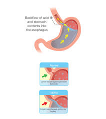 Acid Reflux In Babies Causes Symptoms And Treatment