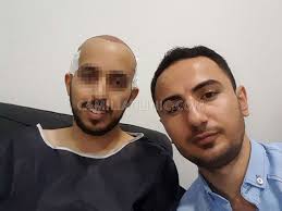 صور من مركز كاميليا كلينك لزراعة الشعر في تركيا 00905444488340 Www Camiliaclinic Com Hair Transplant Hairstyles Plastic Surgery Cosmetic Perkut