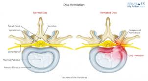 Disc Herniation Rehab My Patient