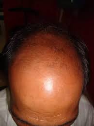 2% is recommended for women and 5% for men i believe. Does Mintop Stop Hair Loss And If I Use Hair Oil Is It Okay To Use It In The Morning And Mintop At Night And What Are Some Other Reliable Products Or