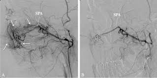 Image result for Epistaxis