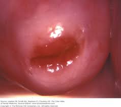 Image result for Colposcopy