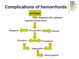 Hemorrhoids