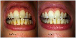 Drinking coffee (or tea or wine) before we give you our tips, let's look very briefly at how coffee and other drinks stain teeth. How To Remove Stains From Teeth Arxiusarquitectura