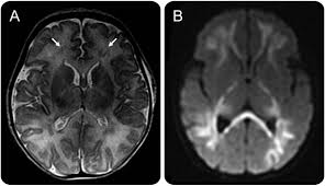 Despite advances in antiviral therapy over the past 2 decades, herpes simplex encephalitis (hse) remains a serious illness with significant risks of morbidity and death. Teaching Neuroimages Neonatal Parechovirus Encephalitis Neurology
