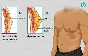 Types vary based on the location of cancer cells and what they look like. Gynecomastia Man Boobs Or Male Breasts Symptoms Causes Prevention Diagnosis Treatment