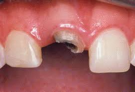 We did not find results for: Fixed Partial Denture Or Single Tooth Implant Restoration Statistical Considerations For Sequencing And Treatment Journal Of Oral And Maxillofacial Surgery