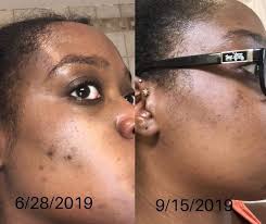 I have been using Sotoks and one drop wonder for 2 months twice daily, my  skin is softer, fine lines and wrinkles are diminishing. Age spots are  diminishing! I am so glad