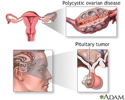 Image result for amenorrhea