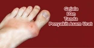 Berikut ialah tanda yang boleh dijadikan panduan mengenali gout: Gejala Dan Tanda Asam Urat