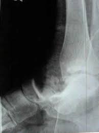 Image result for Subtalar Dislocation