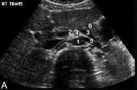Ultrasound Nicks Radiology Wiki Abdominal Aorta Ultrasound Diagnostic Medical Sonography