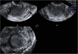 Signs and symptoms of endometrial cancer may include: Endometrial Cancer An Overview Of Novelties In Treatment And Related Imaging Keypoints For Local Staging Cancer Imaging Full Text