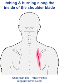 Burning And Itching Along The Shoulder Blade Integrative Works Shoulder Blades Trigger Points Shoulder