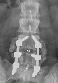 My Back 2 Level Spinal Fusion Spinal Fusion Spinal Surgery Spine Surgery