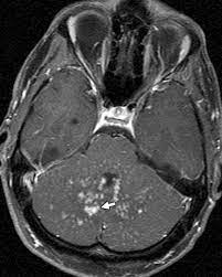 A brain magnetic resonance imaging (mri) showed multiple areas of minimal a crucial role in the diagnosis of clippers syndrome is preserved for mri imaging of the brain and spinal cord because. Case 212 Chronic Lymphocytic Inflammation With Pontine Perivascular Enhancement Responsive To Steroids Radiology