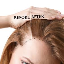 There are several reason as to why one would suffer hairloss. Hair Loss Treatment Malaysia Medication And Injection True Clinic