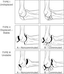 Post the definition of olecranon to facebook share the definition of olecranon on twitter. Olecranon Fractures Sciencedirect