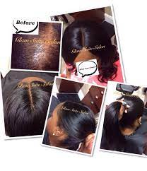 A Client With A Thinning Crown Area She Received A Laceclosure To Cover Her Thinning Crown Area The Perimeter Le Baldness Solutions Stop Hair Loss Hair Loss