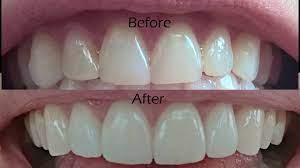 Veneer preparation of tooth structure follows a distinct method. Dental Veneers Procedure Overview Youtube