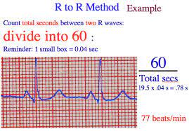 Check spelling or type a new query. Triplets R To R 6 Second Heart Rate Method