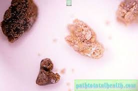 Ia boleh disebabkan kurang cecair dalam badan, terutama air. Batu Alkohol Dan Buah Pinggang Keserasian Kesan Penyakit Dan Keadaan 2021