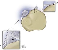 The extensor carpi ulnaris (ecu) muscle plays a key role not only in the active movements of wrist extension and ulnar deviation but also in providing stability to the ulnar side of the wrist. Extensor Carpi Ulnaris Subsheath Reconstruction Sciencedirect